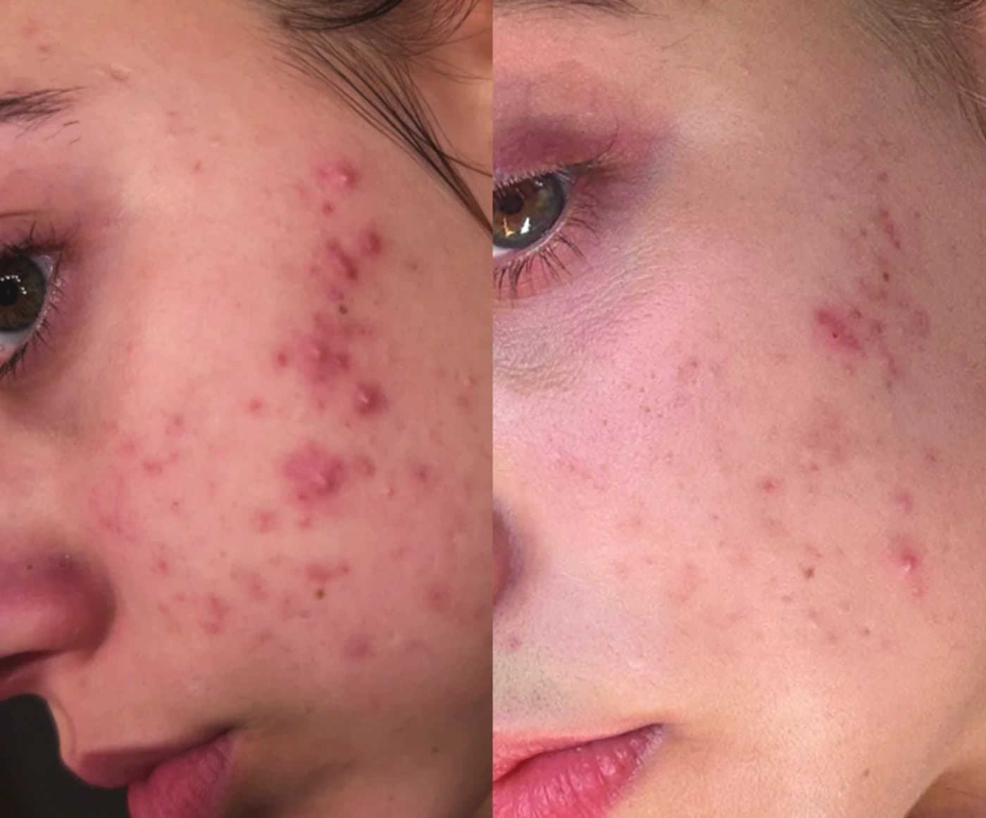 Before and after one month of twice-daily use of the Epicutis Simple System on inflamed breakouts