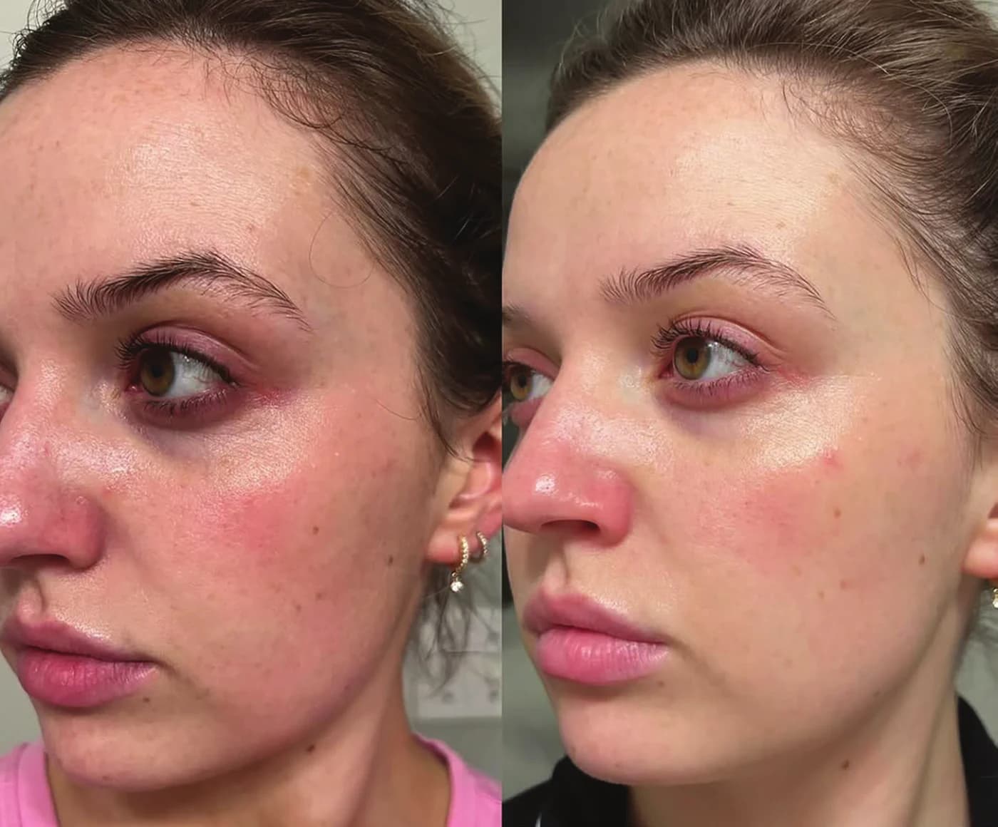 Before and after five consecutive days of the Epicutis Arctigenin Brightening Treatment