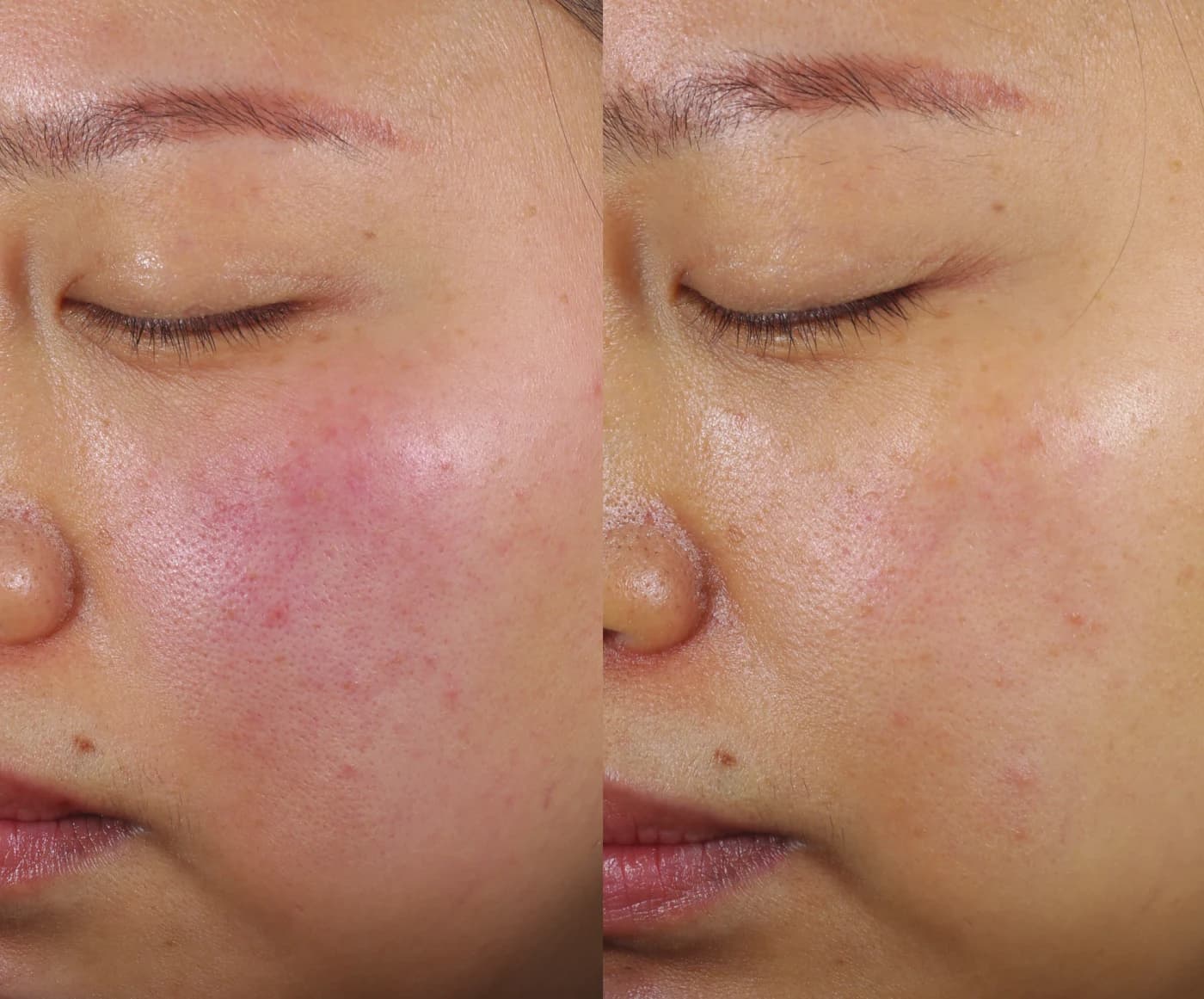 Before and after eight weeks of twice-daily Epicutis Arctigenin Brightening Treatment in a clinical study