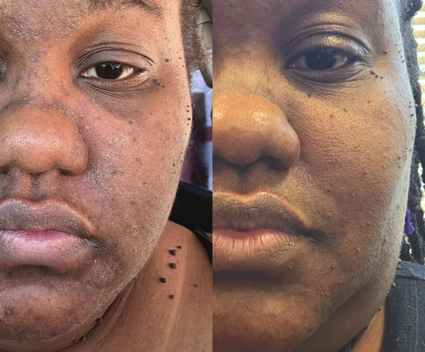 Before and after five months on the Epicutis Simple System for dryness and darkening of the skin