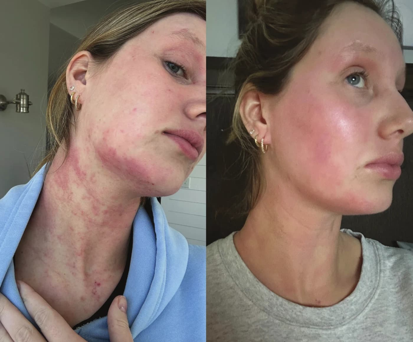 Before and after using the Epicutis Lipid Serum on redness across the face and neck, photographed four hours apart
