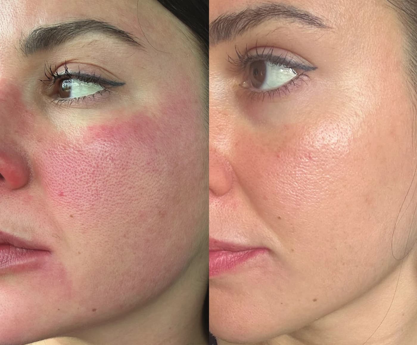 Before and after using the Epicutis Lipid Serum and Arctigenin Brightening Treatment, photographed 24 hours apart