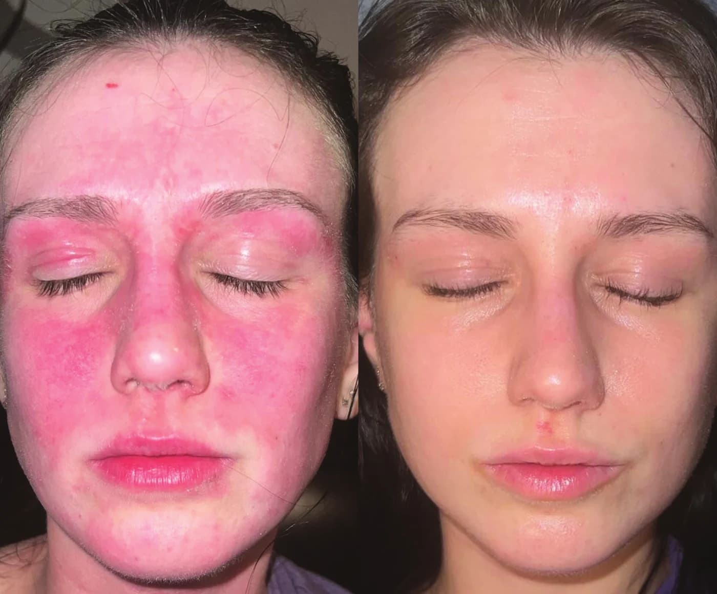 Before and after using the Epicutis Simple System and Lipid Recovery Mask for one week on severe facial redness