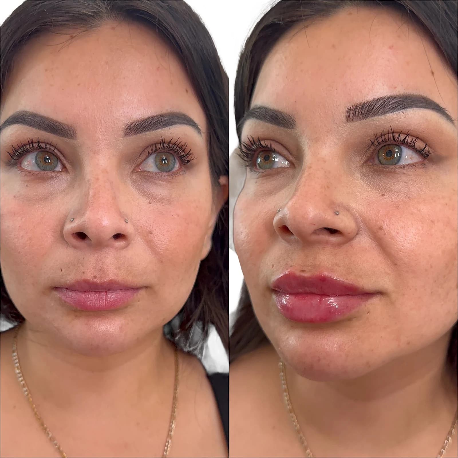 Lip filler before and after — before on the left, after on the right