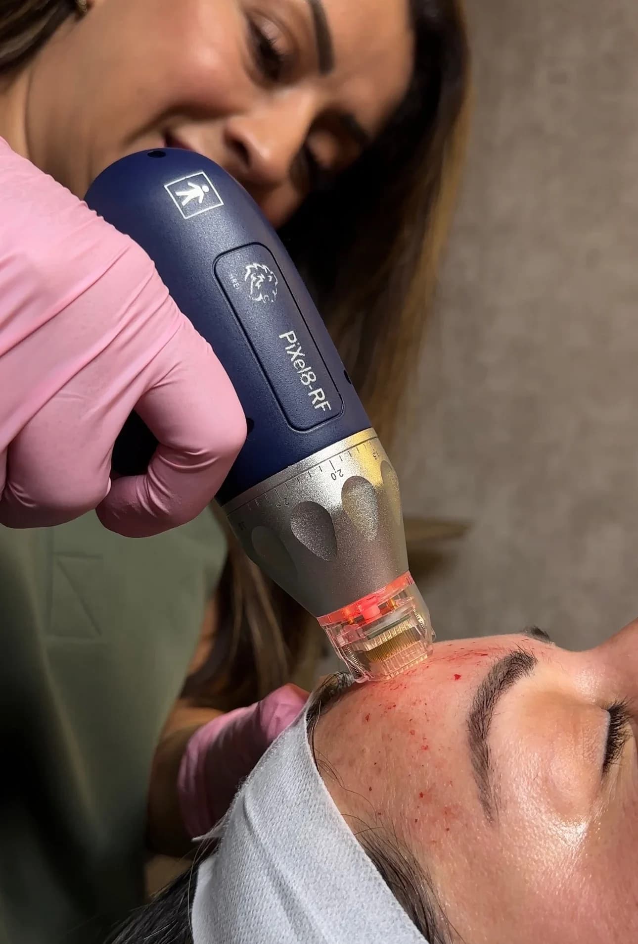 Pixel8 RF microneedling treatment being performed at Revive Beauty Bar in Salinas