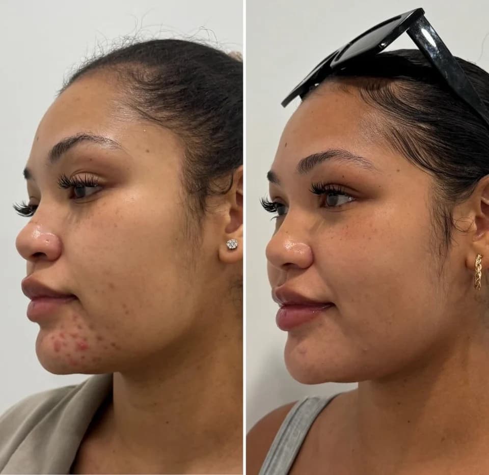 Aerolase Neo Elite before and after at Revive Beauty Bar, Salinas — result 3