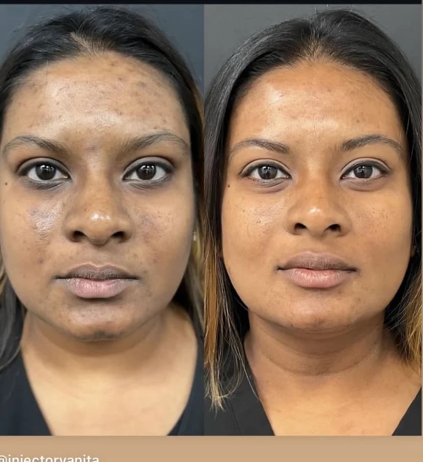 Aerolase Neo Elite before and after at Revive Beauty Bar, Salinas — result 4