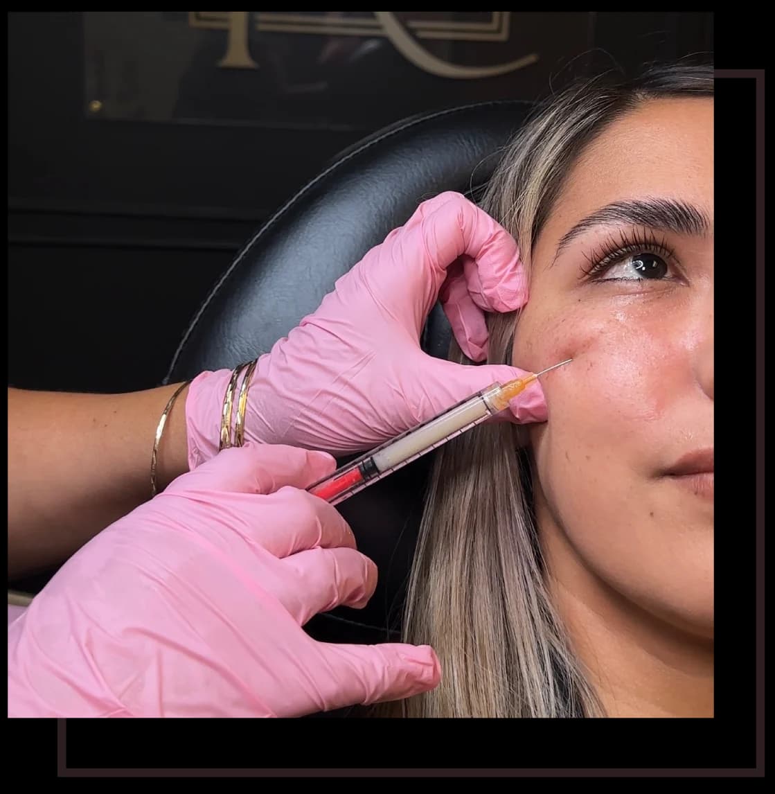 Una inyección de Botox colocada en la mejilla externa por una profesional con guantes en Revive Beauty Bar en Salinas