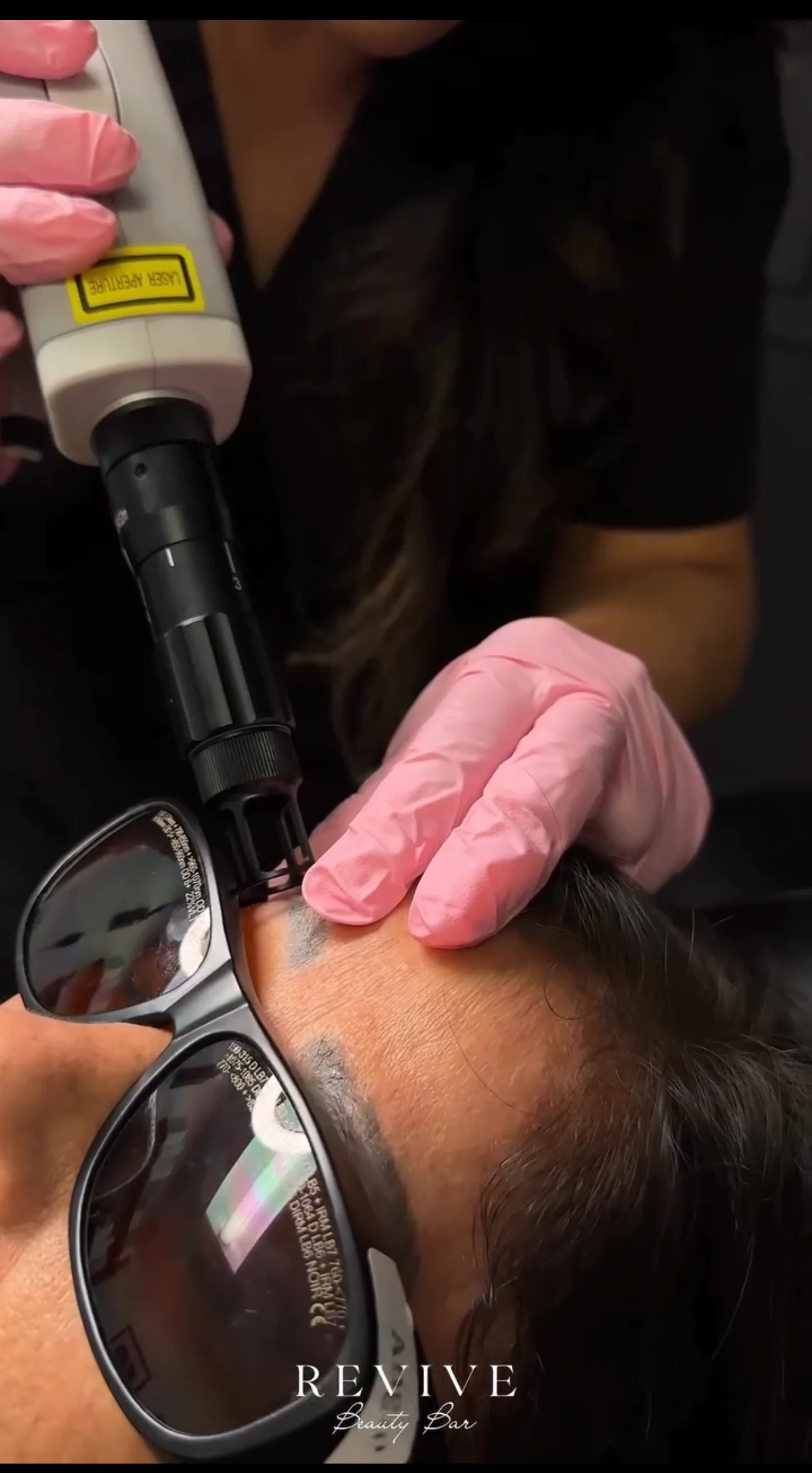 Eliminación de pigmento con láser Q-switched en Revive Beauty Bar en Salinas