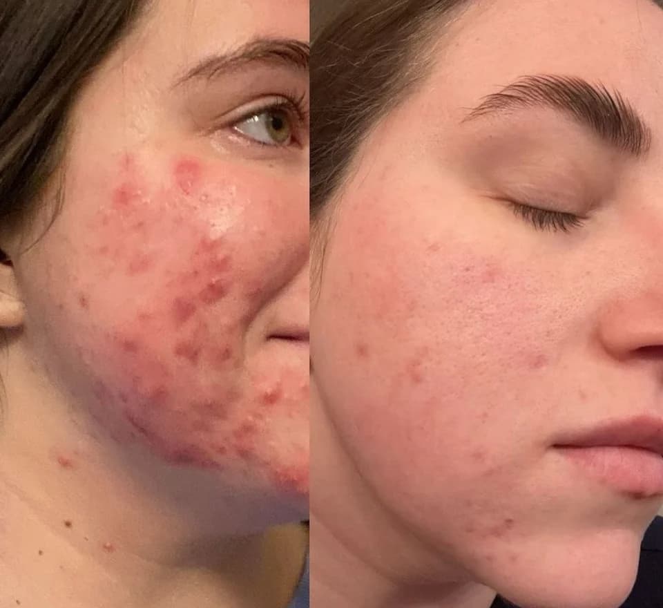 Antes y después de acné con láser Aerolase en Revive Beauty Bar