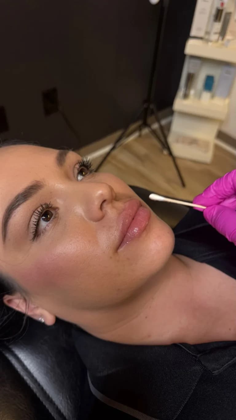 Lip filler result