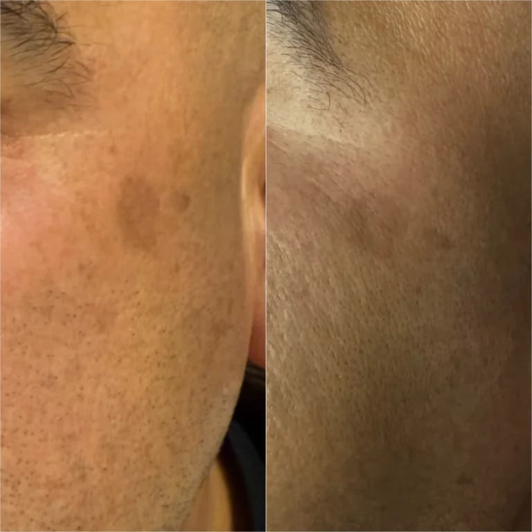 Aerolase pigmented spot removal before and after