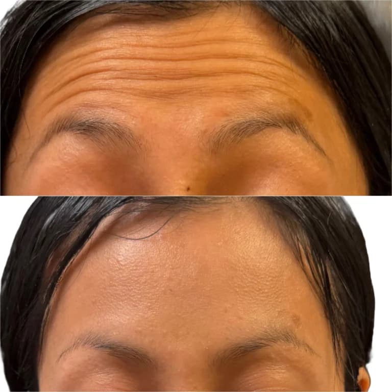 Botox forehead before and after
