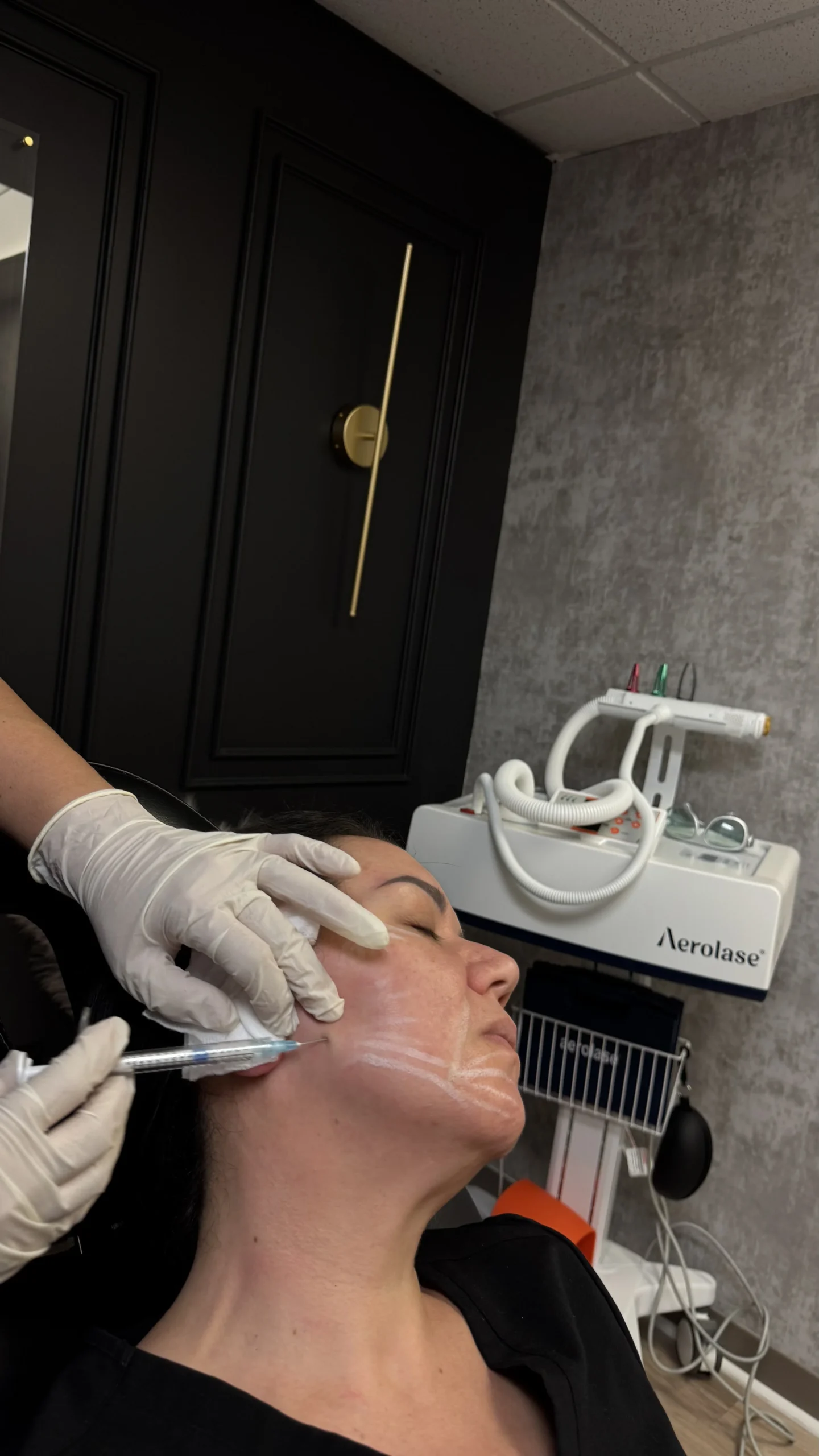 Una clienta recostada con el mapeo de inyección dibujado en la mejilla, durante su tratamiento junto a la consola Aerolase en Revive Beauty Bar