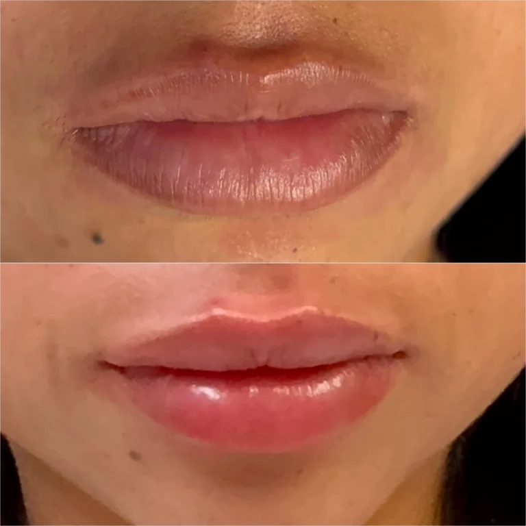 Lip filler before and after