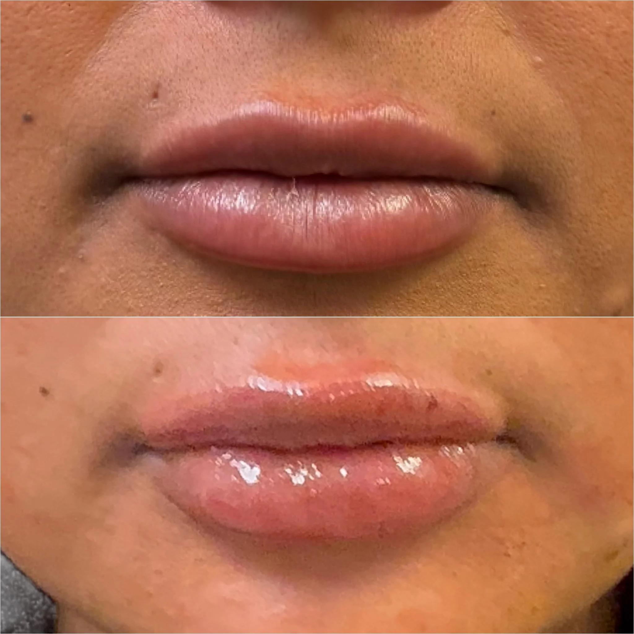 Antes y después de rellenos de labios en Revive Beauty Bar: los mismos labios en primer plano, antes arriba y después abajo