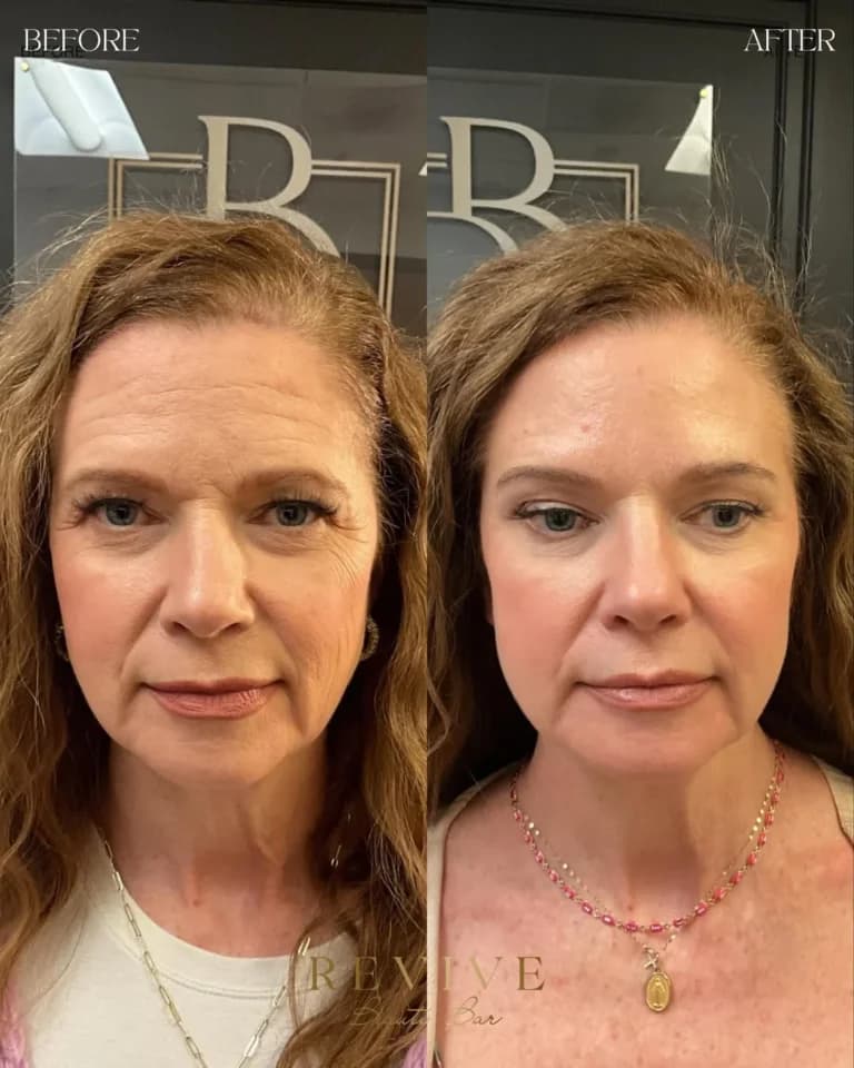 Radiesse before and after