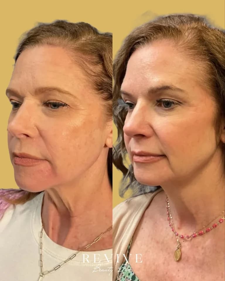 Facial rejuvenation before and after