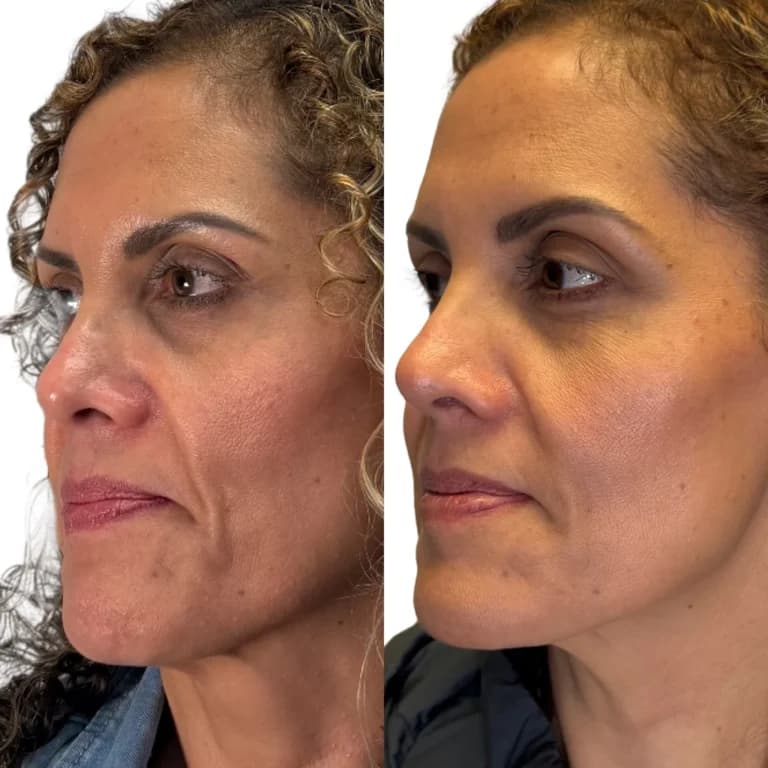 Facial balancing before and after, profile view