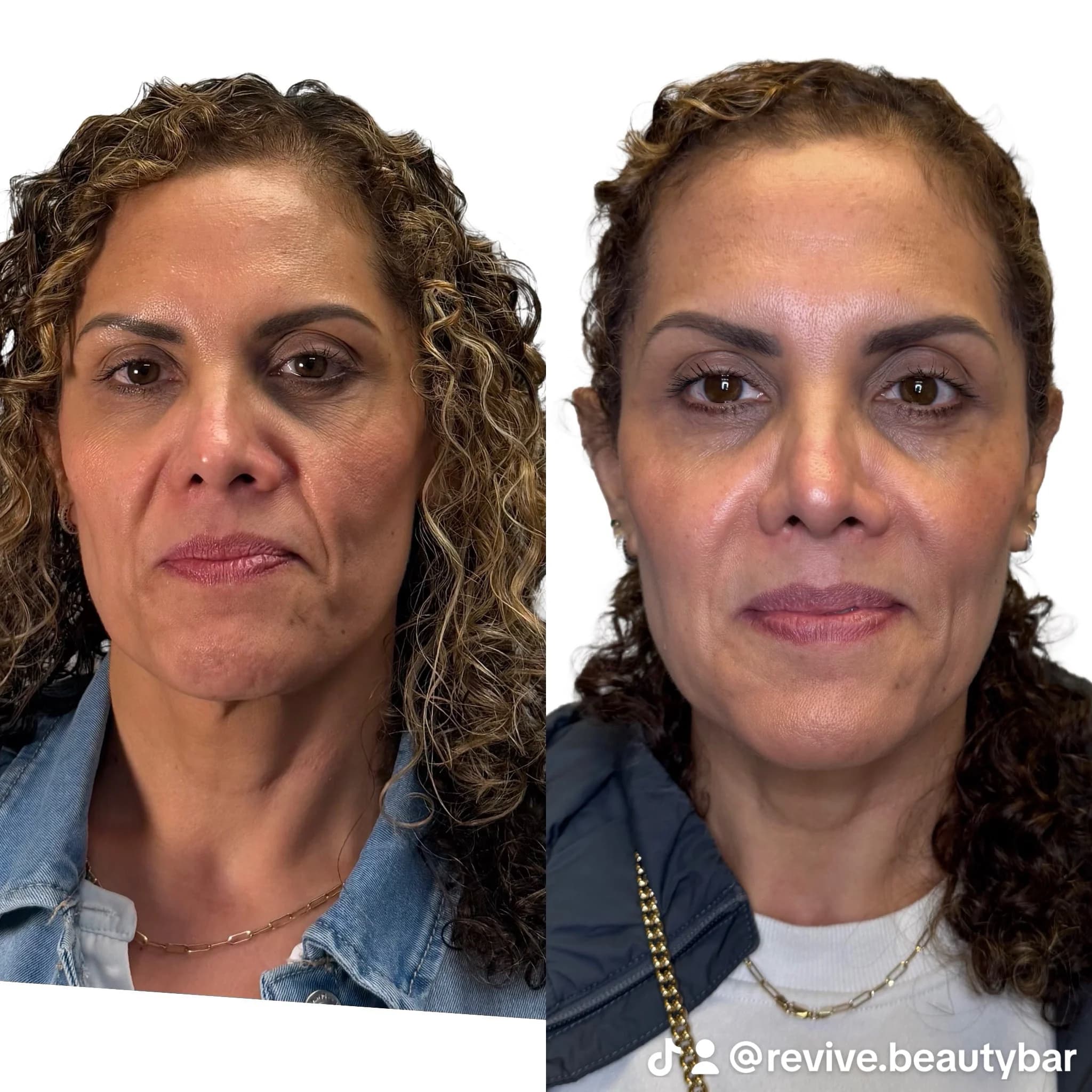 Antes y después de armonización facial en Revive Beauty Bar: la misma clienta fotografiada de frente