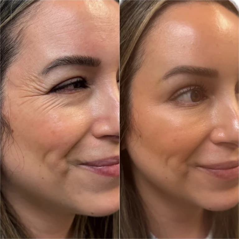 Botox crow's feet before and after