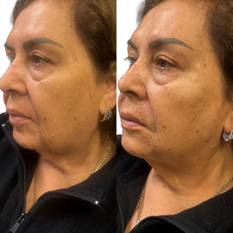 Radiesse before and after