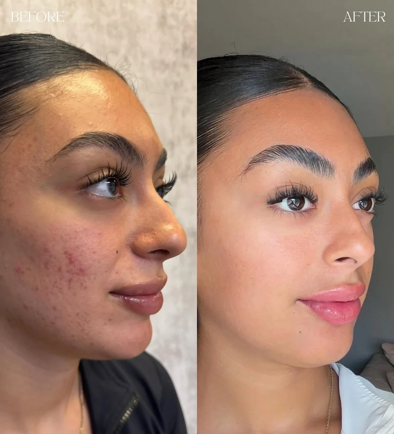Microneedling con SkinPen antes y después en Revive Beauty Bar en Salinas, CA