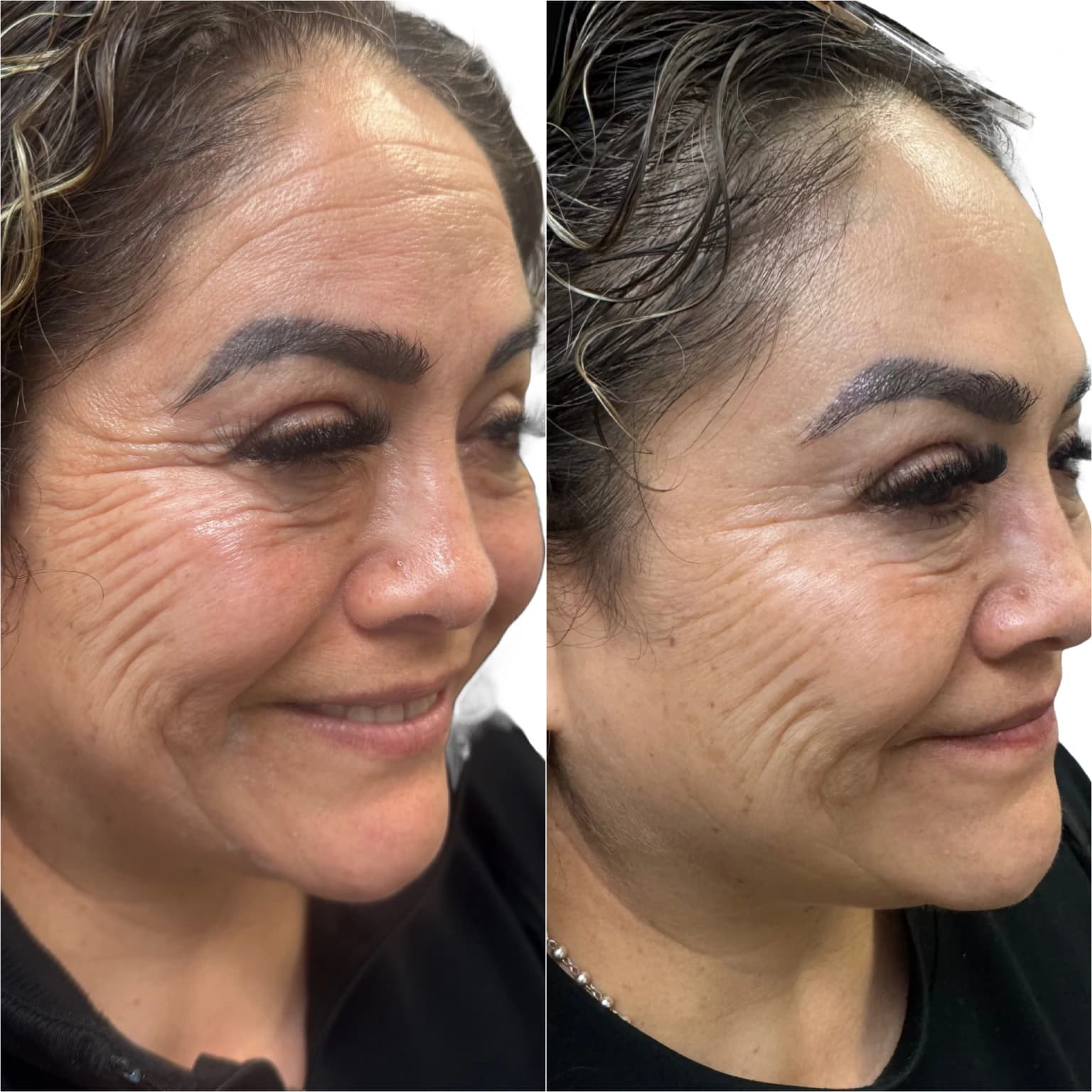 Botox crow's feet before and after, angled view, at Revive Beauty Bar