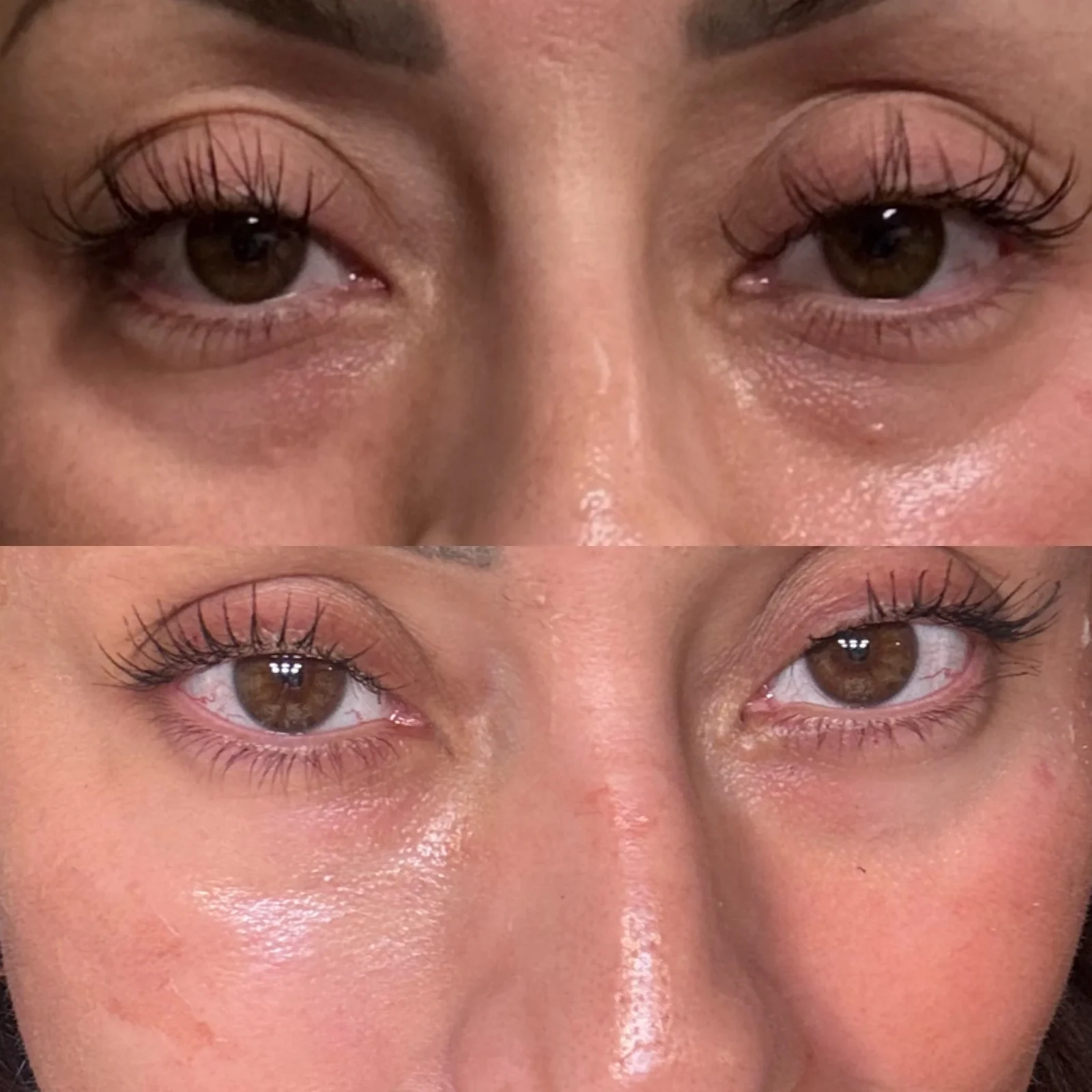 PRF EZ Gel under-eye before and after at Revive Beauty Bar — before above, after below
