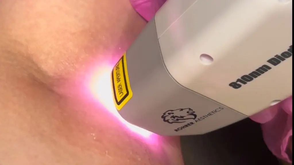 laser removal image