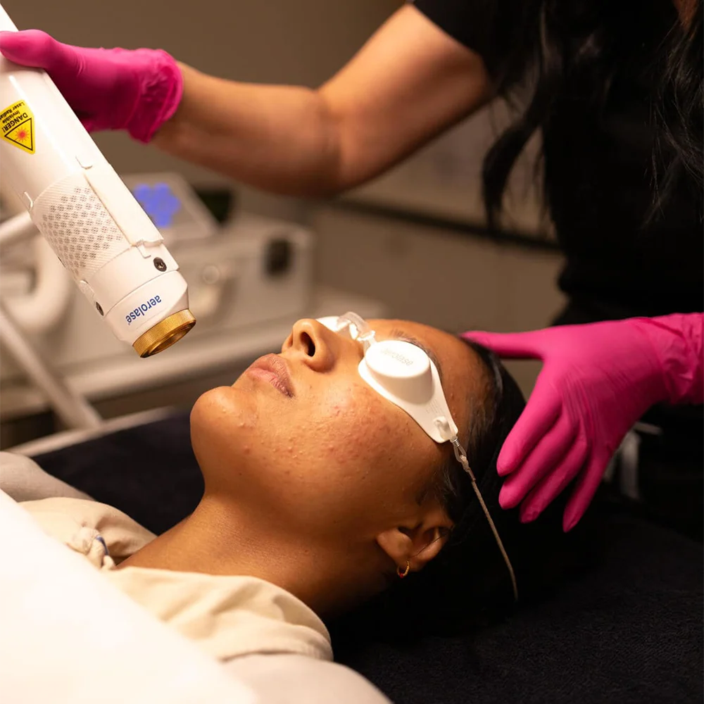 Revive Beauty Bar Aerolase laser for Acne