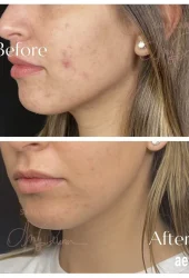 Acne Results by Aerolase