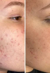 Revive Beauty Bar Acne by Aerolase (10)