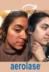 Acne by Aerolase (18)