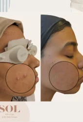 Acne by Aerolase (4)