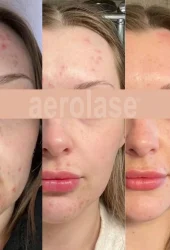 Acne by Aerolase (7)