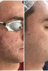 Acne by Aerolase (7)