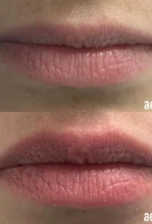Lip Rejuvenation by Aerolase - 1 tx