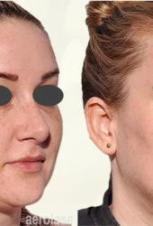 Revive Beauty Bar Aesthetics melasma treatment