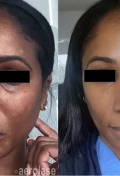 Revive Beauty Bar Aesthetics melasma treatment