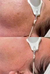 Revive Beauty Bar Aesthetics melasma treatment