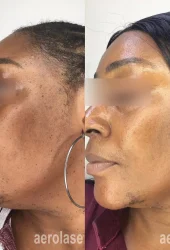 Melasma - Sholema Clinics