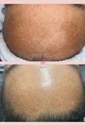 Revive Beauty Bar Aesthetics melasma treatment