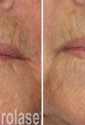 Revive Beauty Bar Aesthetics melasma treatment
