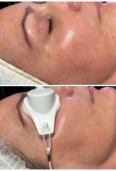 Revive Beauty Bar Aesthetics melasma treatment