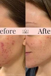 Neo Elite® - Acne (16)