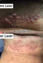 Neo Elite® - Acne (2)