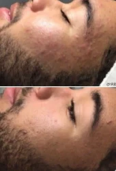 Neo Elite® - Acne (20)