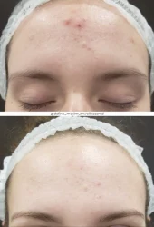 Neo Elite® - Acne (21)