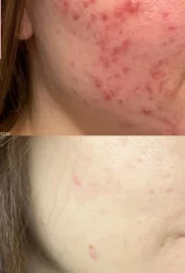 Revive Beauty Bar Neo Elite® - Acne (22)